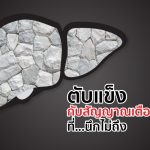 ตับแข็ง , อาการ ตับแข็ง , อาหารเสริม บำรุงตับ
