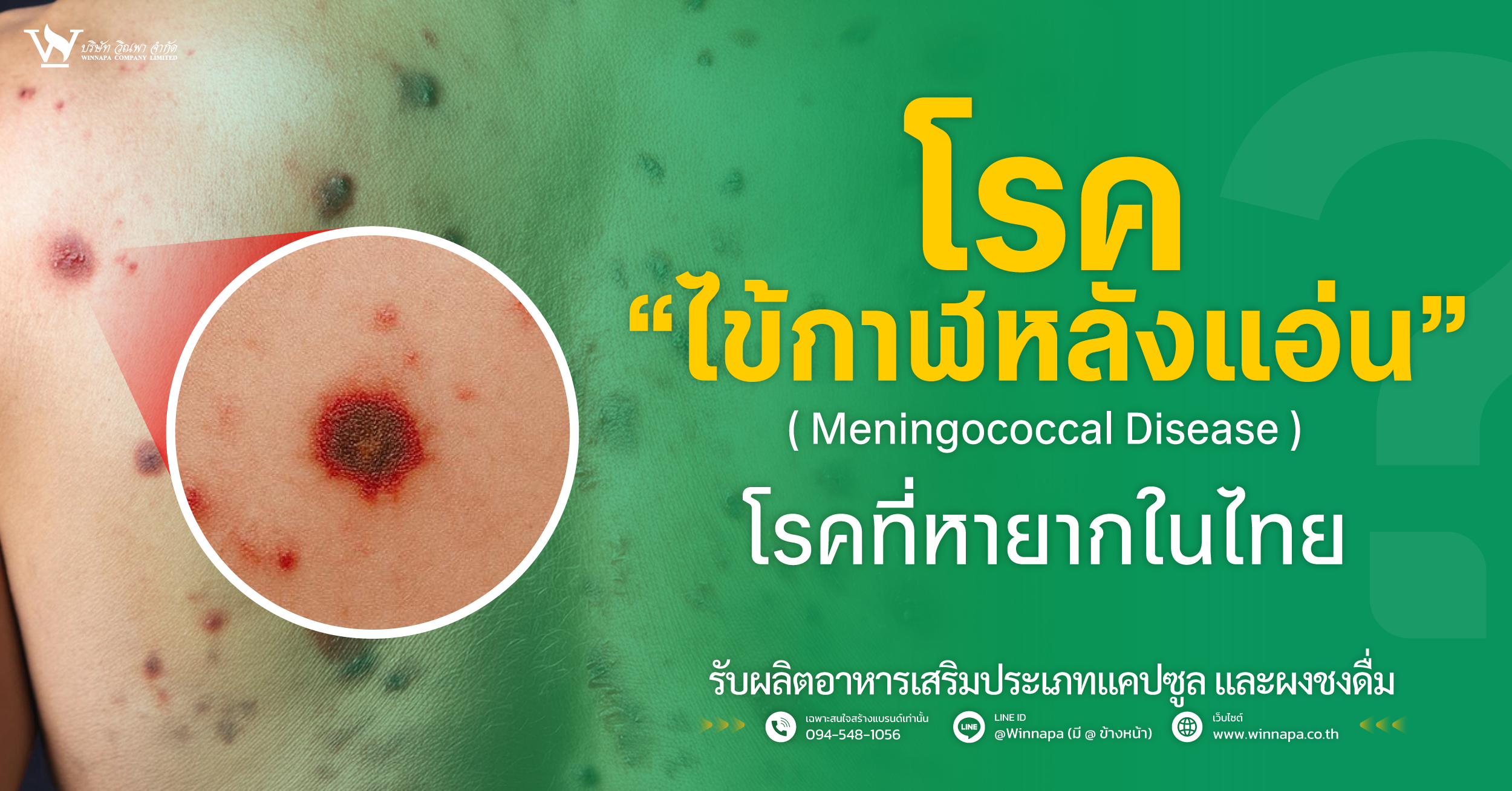 ไข้กาฬหลังแอ่น,ไข้กาฬหลังแอ่นอาการ,ไข้กาฬหลังแอ่นสาเหตุ,ไข้กาฬหลังแอ่นวัคซีน,ไข้กาฬหลังแอ่นเป็นยังไง